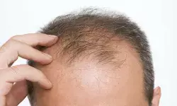 బట్టతలదాచి పెళ్లి..కేసు పెట్టిన భార్య బట్టతలదాచి పెళ్లి..కేసు పెట్టిన భార్య